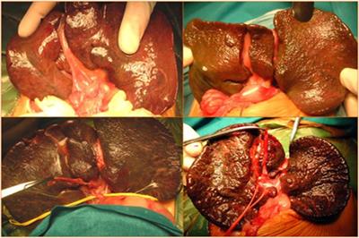 Biliary atresia in preterm infants: a single center experience and review of literature